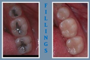 dental fillings photo