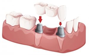 dental bridges photo