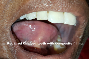 fixed chipped broken teeth photo