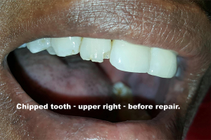 fixed chipped broken teeth photo