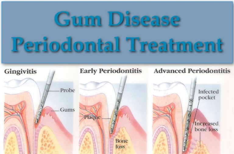 gum disease treatment photo