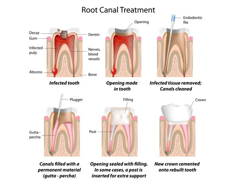 root canal therapy photo